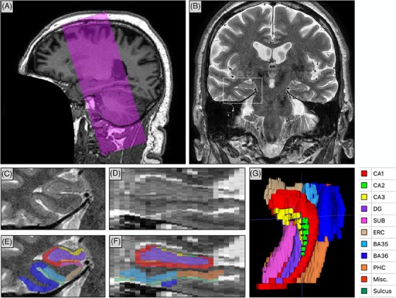 High-resolution imaging of the medial temporal lobe in ADNI