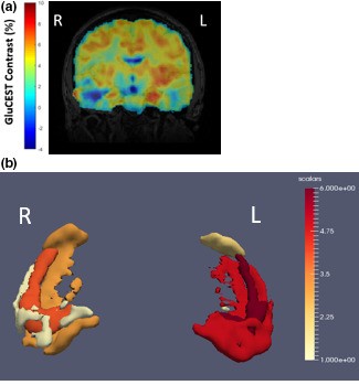3D glutamate imaging at 7T locates seizure onset in nonlesional epilepsy