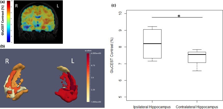 Higher 3D GluCEST signal in the hippocampus on the side of seizure onset. Figure 1 from Hadar et al., Brain and Behavior 2021 , CC BY 4.0 https: creativecommons.org licenses by 4.0 .
