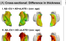 A simple hippocampal volume cut-off flags likely LATE co-pathology