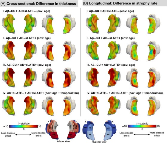 Pointwise differences in medial temporal lobe thickness and atrophy rate between suspected AD LATE groups. Figure 2 from Mundada et al., Alzheimer s Dementia 2025 , CC BY 4.0 https: creativecommons.org licenses by 4.0 .