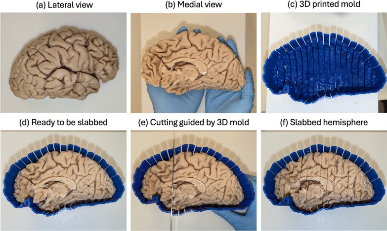 A pipeline for MRI-guided histology in brain banking