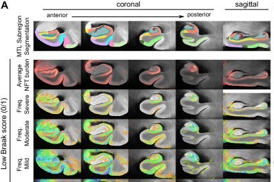 A 3D atlas of tau tangles in the medial temporal lobe