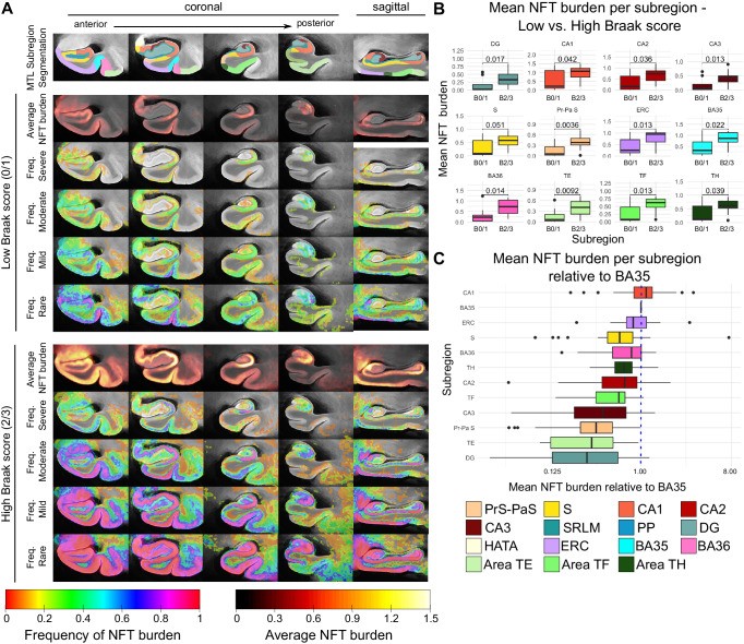 Quantitative tau tangle burden mapped into a 3D ex vivo atlas of the medial temporal lobe. Figure 2 from Ravikumar et al., Nature Communications 2024 , CC BY 4.0 https: creativecommons.org licenses by 4.0 .