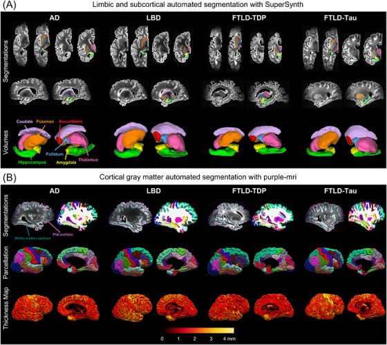 Automated limbic and subcortical segmentation of postmortem MRI in AD, LBD, FTLD-TDP and FTLD-tau. Figure 2A from Khandelwal et al., Alzheimer s Dementia 2026 , CC BY-NC 4.0 https: creativecommons.org licenses by-nc 4.0 .