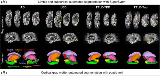 Postmortem MRI links deep brain atrophy to specific neurodegenerative pathologies