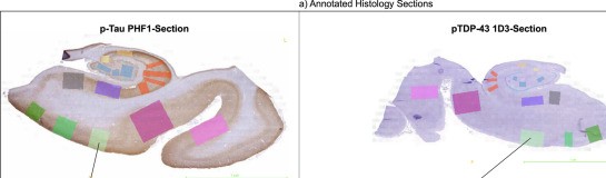 Deep learning measures of tau and TDP-43 explain medial temporal lobe atrophy