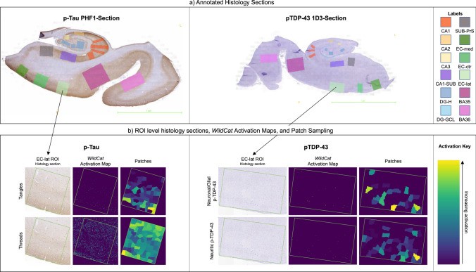 Annotated hippocampal histology sections and deep learning WildCat activation maps for p-tau and TDP-43. Figure 2 from Denning et al., Acta Neuropathologica 2024 , CC BY 4.0 https: creativecommons.org licenses by 4.0 .