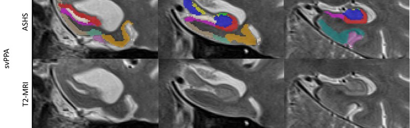 Medial temporal lobe atrophy patterns in semantic variant PPA