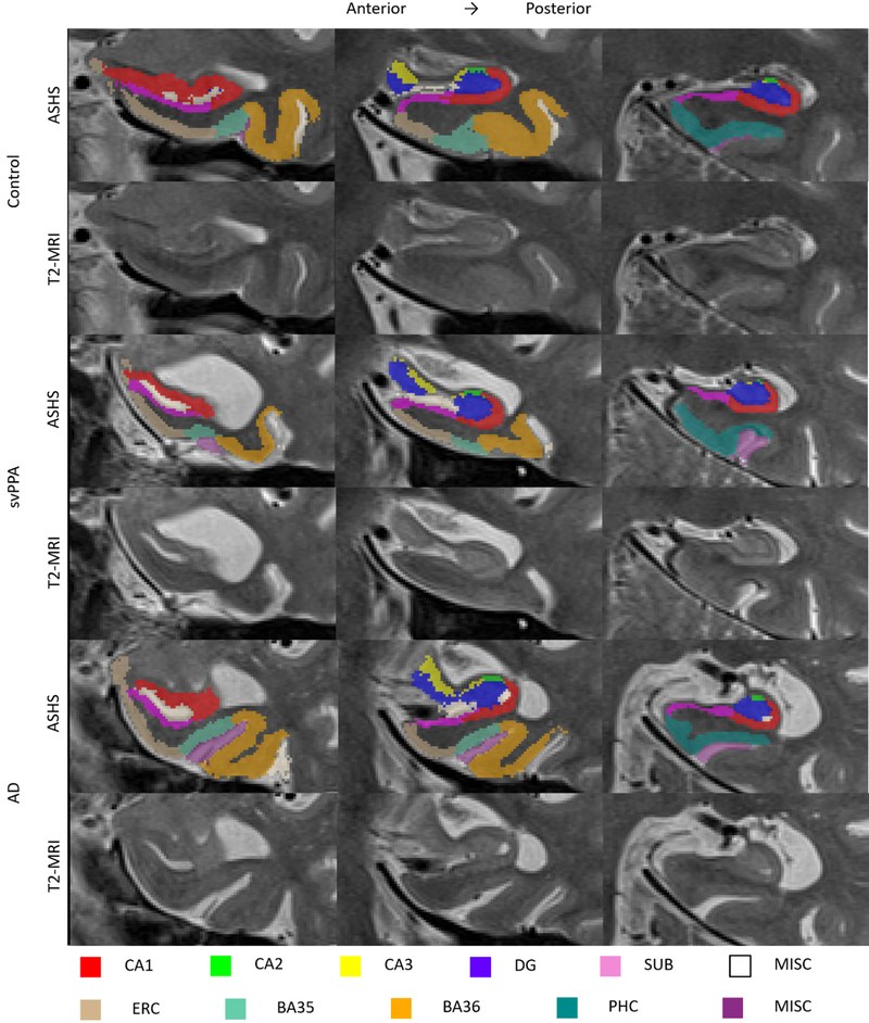 T2-weighted MRI and ASHS segmentation of MTL subregions in representative svPPA, control and AD participants. Figure 1 from Wisse et al., Neurobiology of Aging 2021 , CC BY 4.0 https: creativecommons.org licenses by 4.0 .