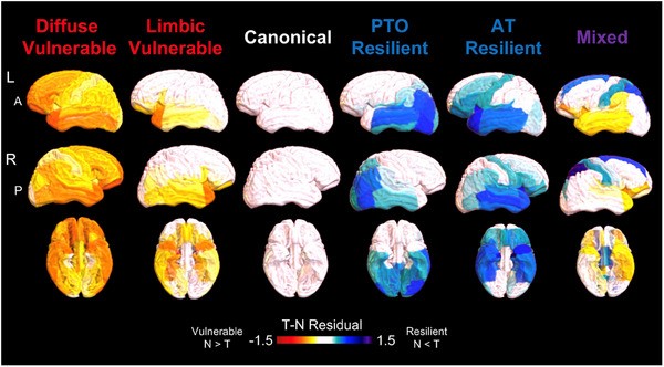 Tau-neurodegeneration mismatch reveals vulnerability and resilience in Alzheimer s