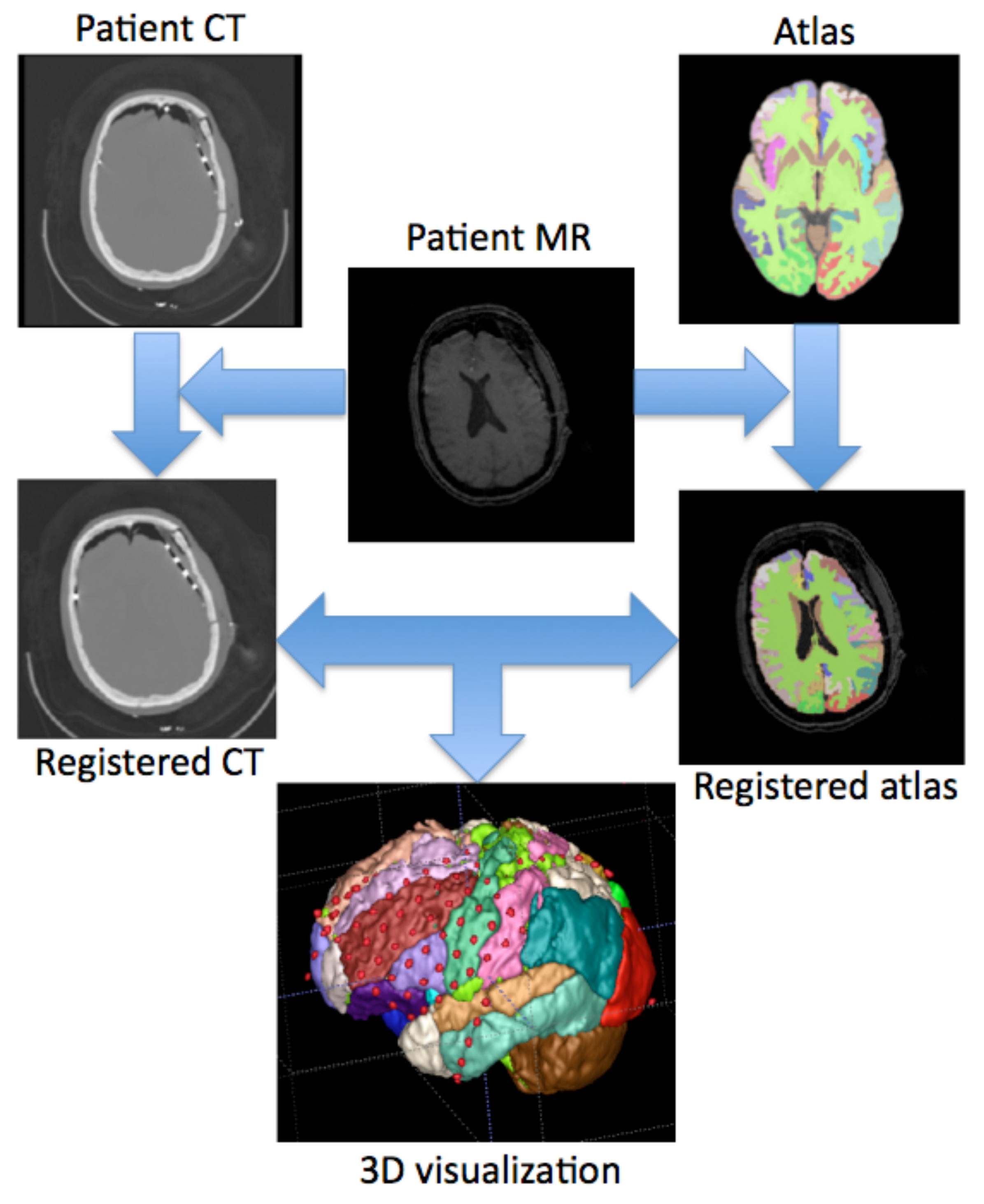 Co-registration and surgical planning in epilepsy