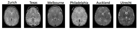 The International Consortium on Brain MRI of Neonates with Congenital Heart Defects