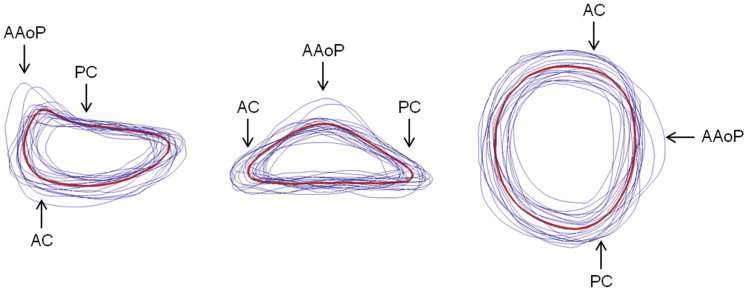 Statistical analysis of normal mitral annular geometry