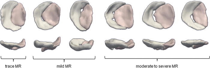Semi-automated segmentation of the mitral leafelts in 3D echocardiographic images