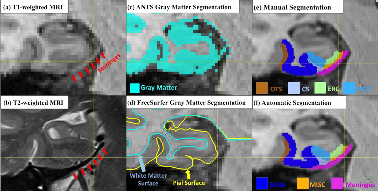 Accounting for the Confound of Meninges in Segmenting Entorhinal and Perirhinal Cortices in T1-weighted MRI