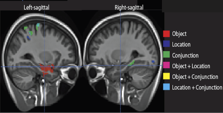 Short-term memory and medial temporal lobe